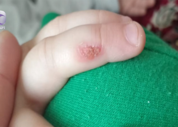 "3 yaşlı uşağım bağçada qağlayanda bıçağı qızdıraraq əlinə basıb" - VİDEO