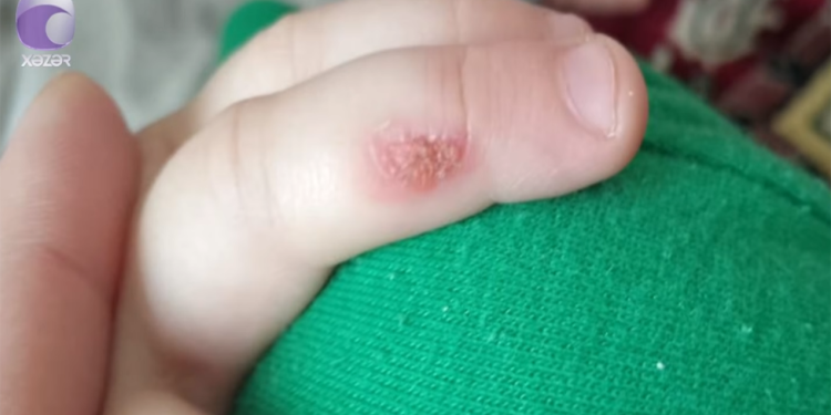 "3 yaşlı uşağım bağçada qağlayanda bıçağı qızdıraraq əlinə basıb" - VİDEO